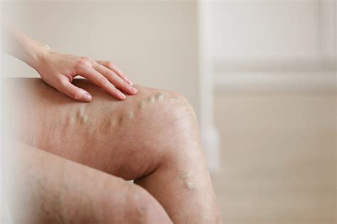Understanding Vein Treatments - Fabio Komlos, MD