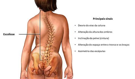 O Que Não Pode Fazer Quando Tem Escoliose - Escoliose Dorsal De Convexidade à Direita - NAZAEDU