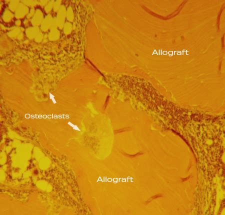 Understanding Sclerotic Bone | SteinerBio™