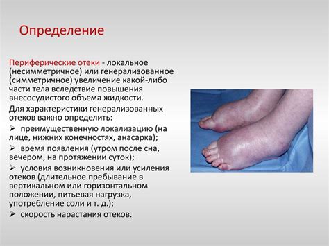 Отечный синдром - презентация онлайн