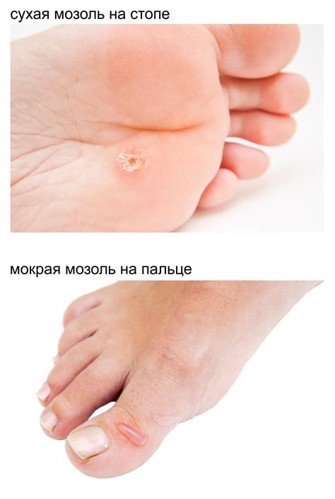 На пятке сухая мозоль как выглядит фото