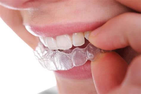 how to remove permanent retainer at home