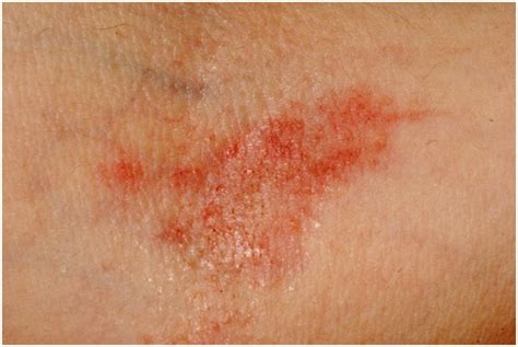 rashes atlantic dermatology