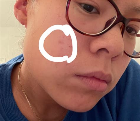 31F. I’ve had this raised bump on my cheek that makes the surrounding