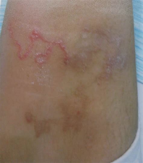 Creeping Eruption (Cutaneous Larva Migrans) : penyakit lama yang muncul