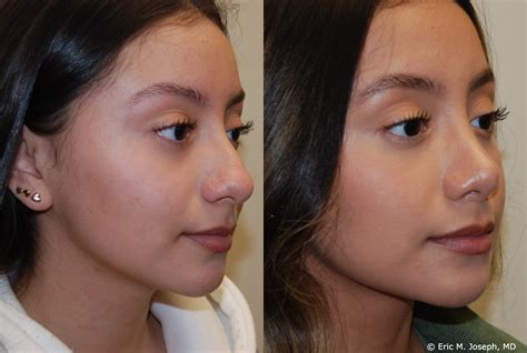 Eric M. Joseph, MD | Rhinoplasty Before & After: Bridge Narrowing and