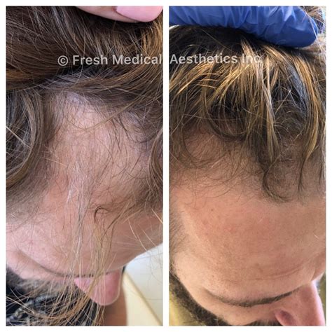 PRP Injections for Hair Restoration | Nonsurgical Anti-Aging in ...