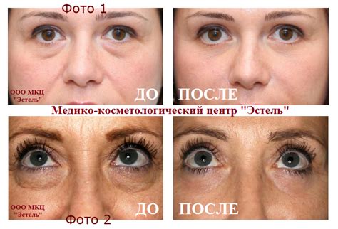 Дермахил от мешков под глазами. отзывы косметологов, фото до и после ...
