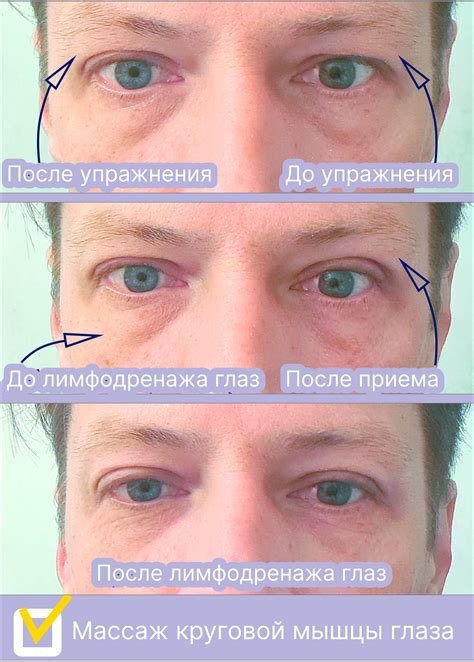 Мастер-класс по эстетическим проблемам глаз. Устранение отека ...