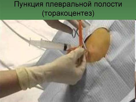 СП при плевритах - презентация онлайн