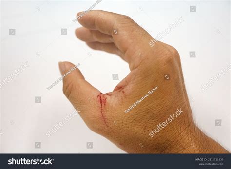 fresh wound sickle cut  thumb stock photo  shutterstock