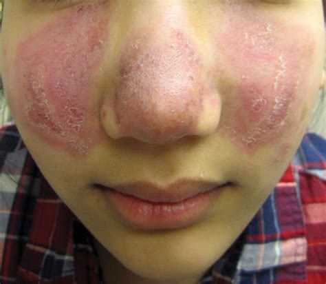 Lupus Pernio Nose