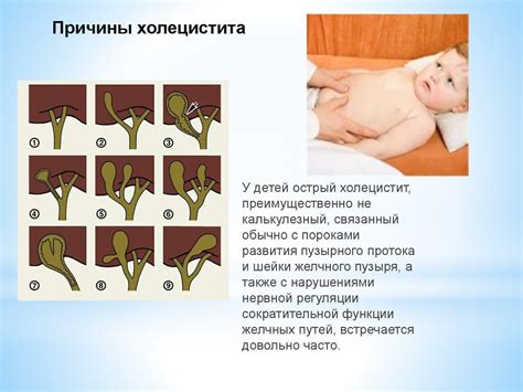 Холецистит у детей - презентация онлайн