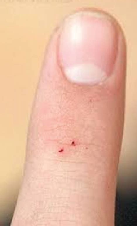Bat Bite