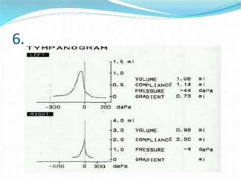 Tympanometry