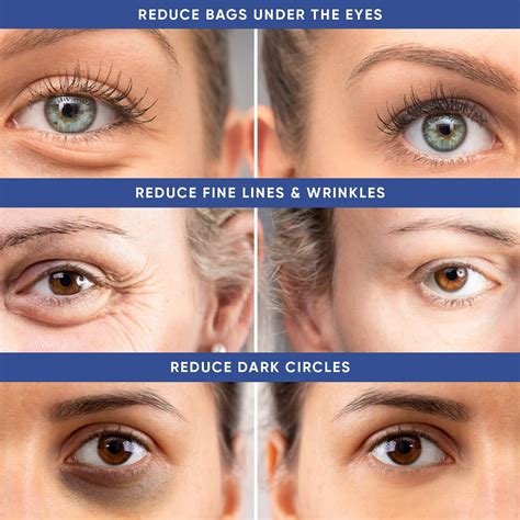 Severe Puffy Under Eyes