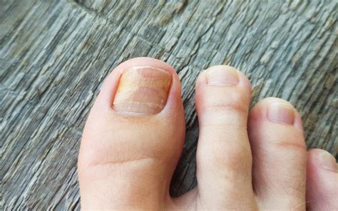 How Can You Treat Toenail Fungus? – Violence Prevention NB