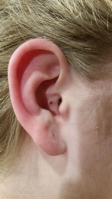 huge blackhead pop 4