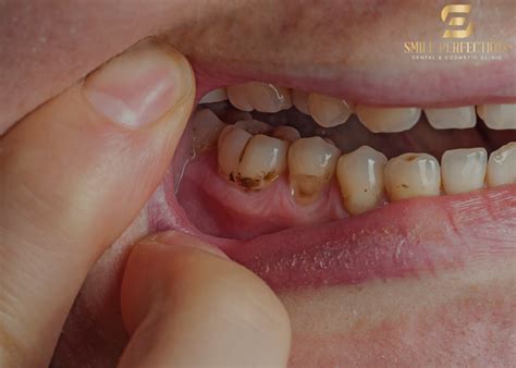 how to remove a wobbly tooth at home