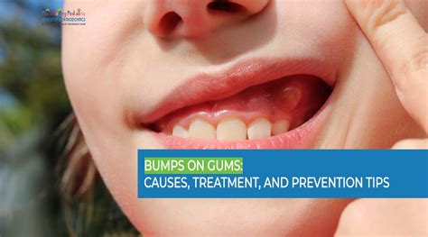 Roof of Mouth Swollen? 6 Causes and 5 Remedies to Try