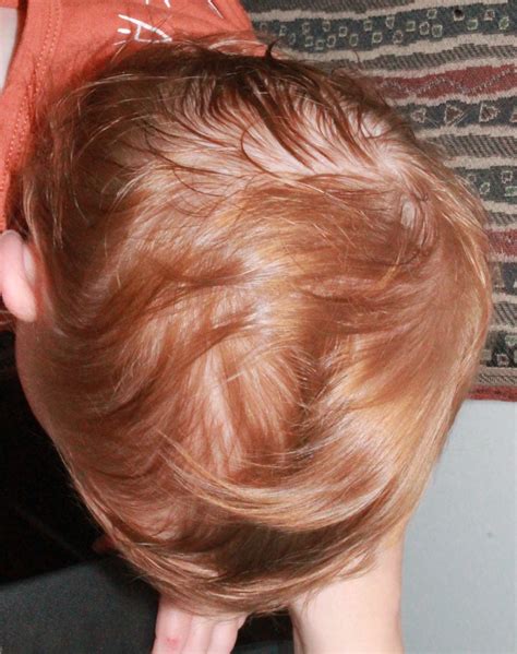 Before & After Archive - Kansas Cleft and Craniofacial Center