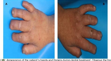 Figure 2 from Congenital Insensitivity to Pain with Anhidrosis (CIPA ...