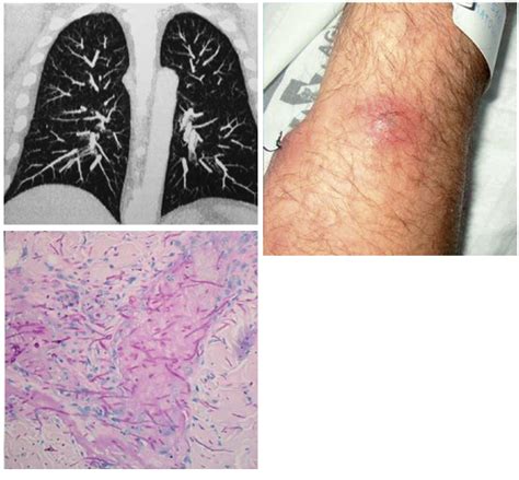 O Que É Eczema Pulmonar - Manifestaciones cutáneas de la enfermedad pulmonar aguda | Piel ...