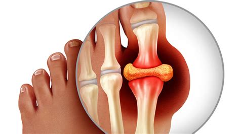 Gout | Arthritis | CDC