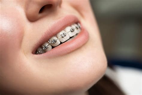 Types of Braces - Bellevue Orthodontics & Smile Design - Bellevue, WA