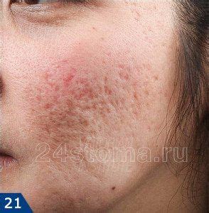 Шрамы на лице после акне | Skin, Behind ear tattoo, Acne