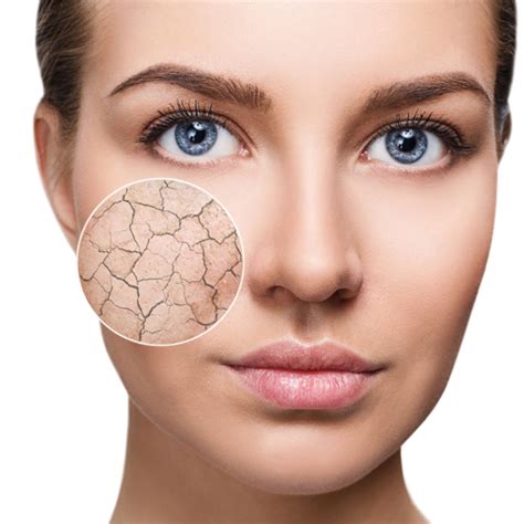 Dry Skin Type • Treatments & Skincare • NASCENT Skin Clinic