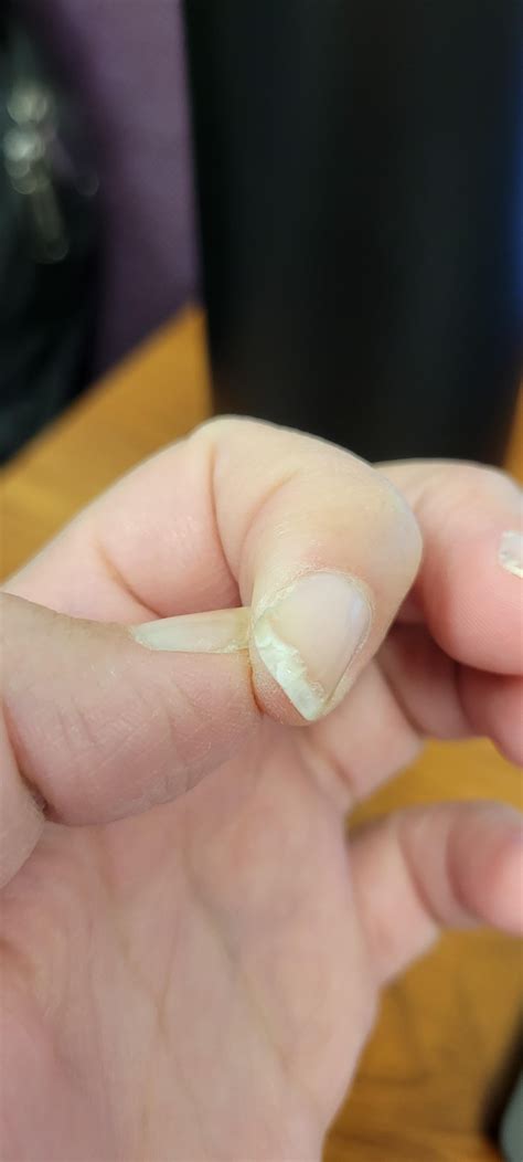 how to fix splitting nails