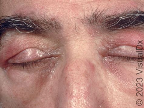 DERMATOMYOSITIS (DM) Let’s spend some time in this #tweetorial on the ...