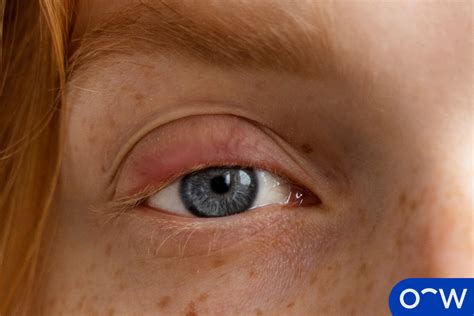 Puffy Eyes: Definition, Causes, Symptoms, and Treatment
