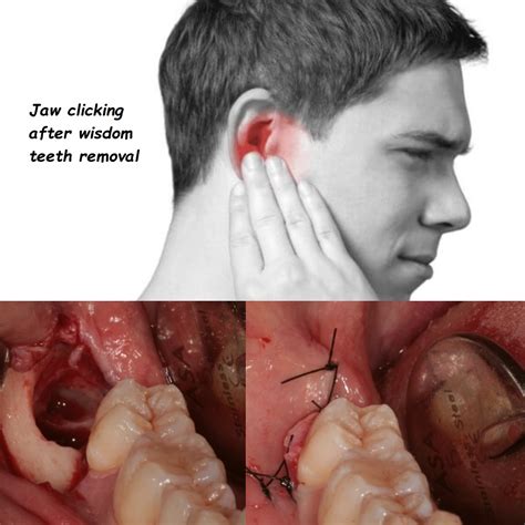 jaw clicking  wisdom teeth removal