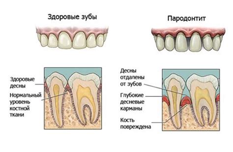 пародонтит | Бережіть здоров'я!