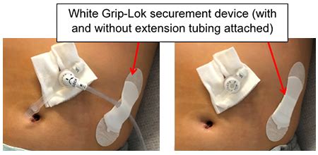 Gastrostomy Button