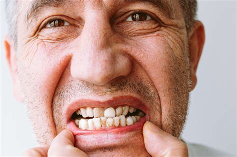 Biofilme dental: características, estágios e como tratar