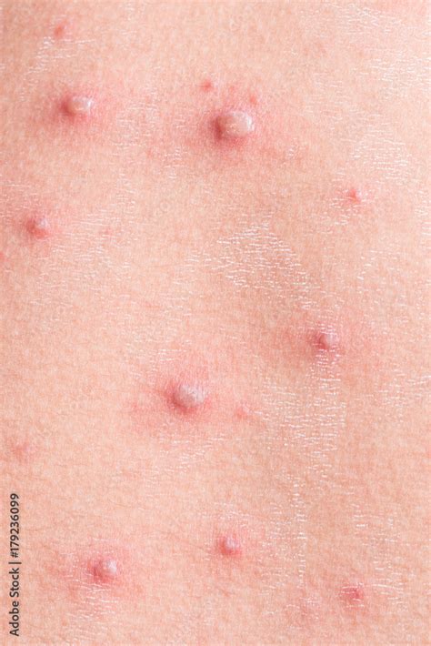 chicken pox rash stock photo adobe stock