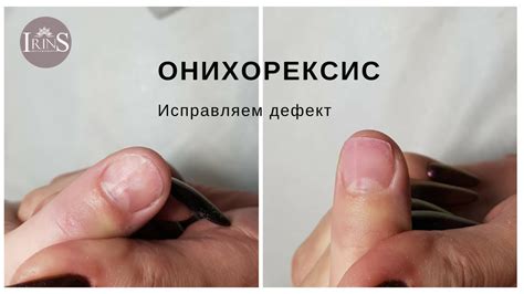 Онихорексис. Исправляем дефект - YouTube