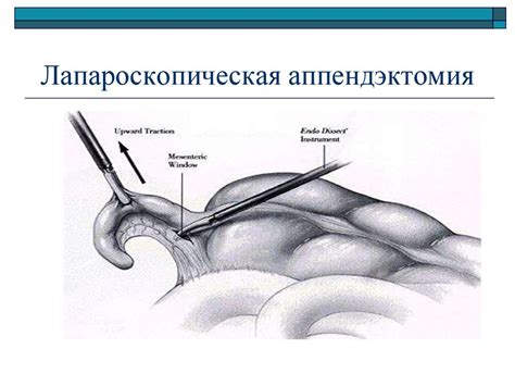 Острый аппендицит - online presentation