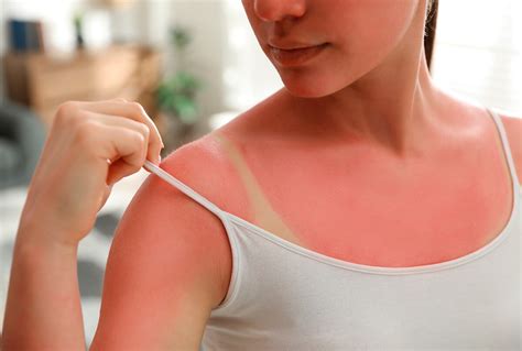Como Tirar Vermelhidão Do Sol Rápido