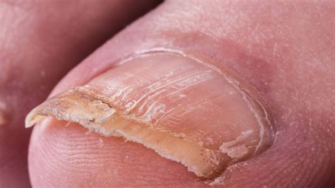 Onychomycosis: when the fungus is on the nails | Bullfrag