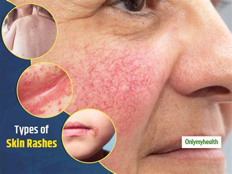 Cause Of Skin Rash In Adults at Nicholas Erwin blog