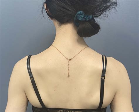 Plastic Surgery Case Study - Shoulder Narrowing Osteotomies Combined