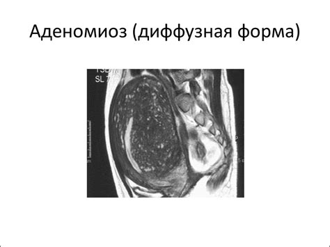 МРТ органов женского малого таза. Доброкачественные образования. Миома ...