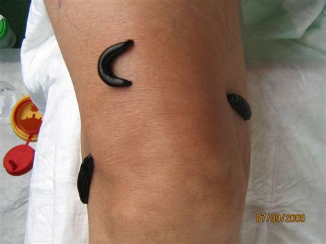 Leeches on knee- alternative therapy for arthrosis - DocCheck