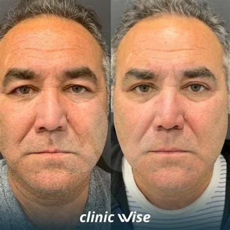 Eyelid Surgery (Blepharoplasty) Before After - Clinic Wise