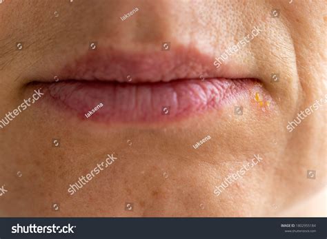 Corner Of The Mouth Pimple at Nichelle Hock blog