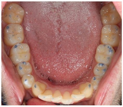 Digital Quantification of Occlusal Contacts: A Methodological Study